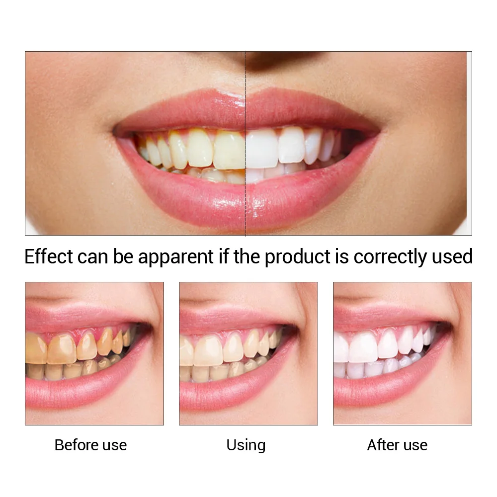 FTEENPLY Teeth Whitening Essen - Teeth Whitening Co ulasan dan harga