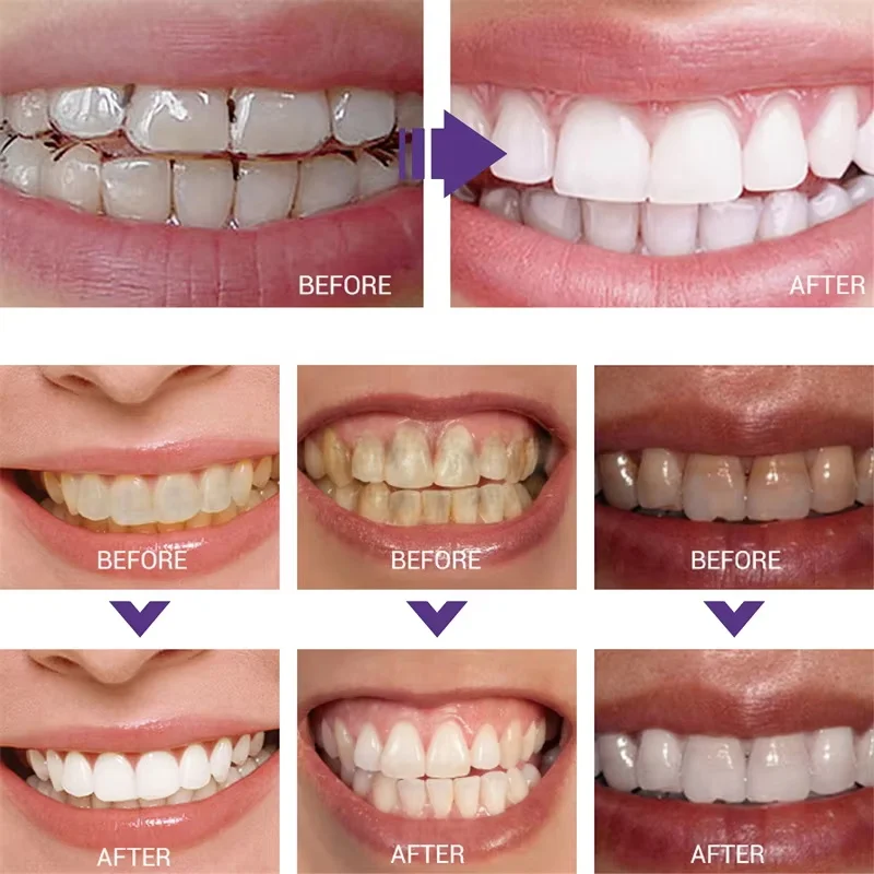 Whitening Toothpaste Teeth Cle - Teeth Whitening In Korea ulasan dan harga